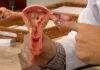 Endometriose: conheça os sintomas e saiba como tratar a doença
