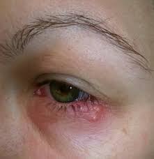 Herpes Ocular: Estresse Pode Desencadear a Reativação do Vírus